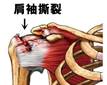 沒有受傷也會肩膊痛 隨時要置換肩膊關節